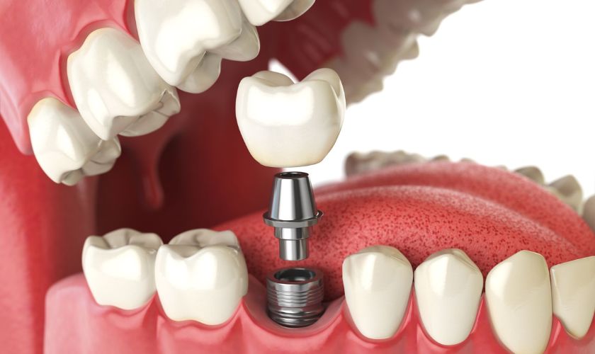 Unlock Your Perfect Smile: How Dental Implants Can Transform Your Confidence!